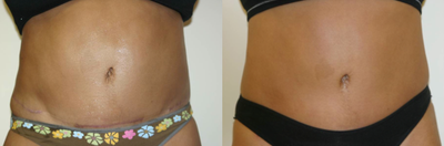 TriPollar - 
	Tummy skin tightening and fat reduction after 8 treatments. Photos supplied by manufacturer, Pollogen Ltd, All Rights Reserved.
