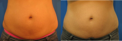 TriPollar - 
	Tummy skin tightening and fat reduction after 7 treatments. 4 cm reduction in tummy circumference. Photos supplied by manufacturer, Pollogen Ltd, All Rights Reserved.
