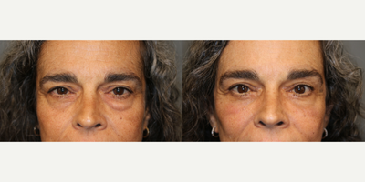 Browlift, upper and Lower Lid Surgery, Fat Transfer - Minimally invasive lower facelift with eyelid surgery