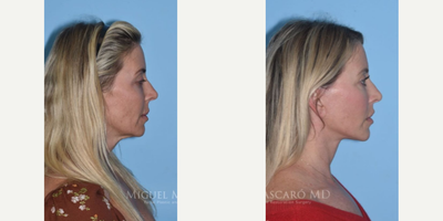 Woman treated with Lip Lift - Woman treated with Deep Plane Facelift, Lip Lift, Facial Fat Transfer, and Eyelid Surgery. Patient is shown before and over a year post-op.