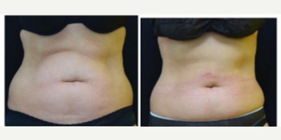25-34 year old woman treated with CoolSculpting - Patient treated with CoolSculpting to the Abdomen (upper and lower)