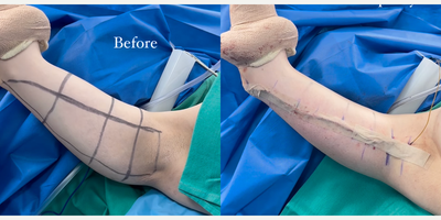 45-54 year old woman treated with Arm Lift, Liposuction - Our lovely patient in her 50s had lost 70 pounds and was ready for an arm lift and reduction. The arms can be a stubborn place for skin to snap back after weight loss. Just doing liposuction will leave you with loose, hanging skin.