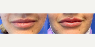Woman treated with Juvederm - Woman treated with 1 syringe of Juvederm Ultra for fullness and hydration