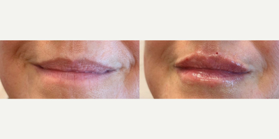 Woman treated with Juvederm - Woman treated with 1 syringe of Juvederm Ultra XC for subtle volume and added hydration