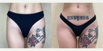 Woman treated with Hip Augmentation - Woman treated with Hip Augmentation using implants