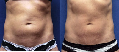 35-44 year old woman treated with ThermiTight - ThermiTight Abdomen