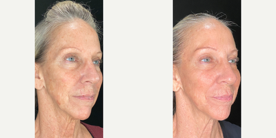 55-64 year old woman treated with Opus Plasma, IPL, Fractional Laser - This client wanted to address her skin laxity and hyper-pigmentation. We chose to do a series of combination treatments. This is 4 weeks after her 3rd treatment!