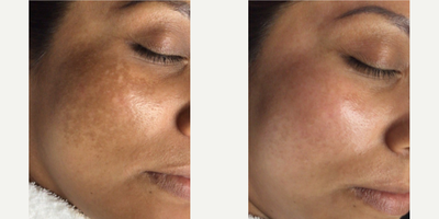 35-44 year old woman treated with Skin Rejuvenation, LaseMD - Patient had dark pigmentation on face. Treated with a combo treatment of Vivace micro needling and Lase Md. together with use of our products and peels.