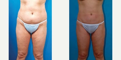 35-44 year old woman treated with Liposuction - Procedure: Liposuction of lower body, arms and axillae, and breast augmentation.Before, 16 months after