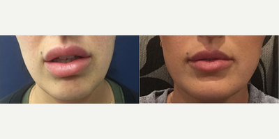 Woman treated with Lip Augmentation - Woman treated with Lip Augmentation
