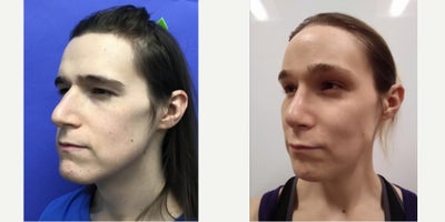 35-44 year old transgender woman treated with Brow Lift, Forehead Reduction, Septoplasty, Cheek Augmentation, Adam's Apple Reduc - 35 to 44 year-old female patient is 1 year post-op from Facial Feminization surgery. Her procedures included: Forehead Lift, Hairline Lowering, Supra Orbital Bone Reduction and Contouring, Septorhinoplasty (closed) with Cartilage Grafts and Weirs, Cheek Implants (small combined), Chin Reduction and Contour, Thyroid Cartilage Shave, 300 Micrografts to the Frontotemporal Recessions, Lip Lift, Fascia to Lips, Soft Tissue to Nasolabial Folds, Lower Eyelid Blepharoplasty (TC), and 1 cc Juvederm to Facial Rhytids.
