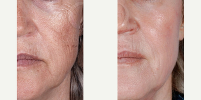 45-54 year old woman treated with Skin Rejuvenation - Before: Wrinkles & Pigmentation
After: Firm, tight and smoother skin.