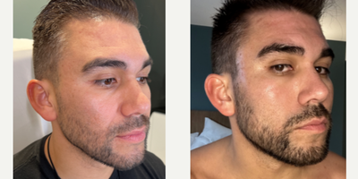 SIMPLY SENSATIONAL THREADS - Our patient is the face of a YouTube channel that has a million subscribers, so he only trusts the best with his face. While he already has great facial features, we will be contouring and sculpting his face with Miracu PDO threads for an enhanced, rejuvenated look. We used the threads in his mid face and lower face, crossing the two zones to maximize his results. He is blown away by how amazing his final results are!