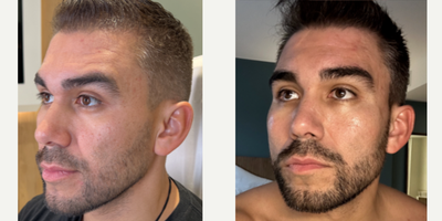 SIMPLY SENSATIONAL THREADS - Our patient is the face of a YouTube channel that has a million subscribers, so he only trusts the best with his face. While he already has great facial features, we will be contouring and sculpting his face with Miracu PDO threads for an enhanced, rejuvenated look. We used the threads in his mid face and lower face, crossing the two zones to maximize his results. He is blown away by how amazing his final results are!