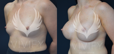 35-44 year old woman treated with Mentor Breast Implants - Patient underwent bilateral breast augmentation with Mentor MemoryGel Xtra 490 cc moderate plus profile submuscular (dual plane) implants through an infra-mammary approach.