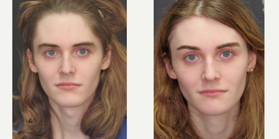 18-24 year old woman treated with Adam's Apple Reduction - This patient wanted subtle improvements and underwent phase 1 facial feminization surgery. Her primary concerns were her hairline, brow position, and adam's apple. She underwent Trichophytic Brow Lift, with glabella reduction and hairline advancement, tracheal shave, and osteoplasty of the jaw to narrow the chin and remove the cleft. The lateral view is best demonstrates the adam's apple reduction.