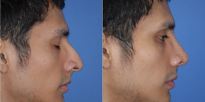 Man treated with Asian Rhinoplasty - Man treated with Asian Rhinoplasty