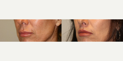 Woman treated with Lip Surgery - Woman treated with Lip Surgery through Lip Lift. Pre-op, she did not like the way her upper lip appeared long. She tried fillers but, although they increased the size of the lip, they did not create the right balance to the mouth and face.