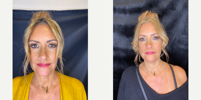 45-54 year old woman treated with Skin Tightening - Evoke by InMode is cutting edge, innovative facial remodeling technology that restructures the skin and underlying adipose tissues in your face and neck regions. The Evoke treatment allows you to rejuvenate your facial structure without surgeries, incisions, or downtime. It pairs well with these options but does an excellent job as a stand-alone treatment. Evoke is totally non-invasive. It is a comfortable treatment that works to remodel your facial skin so it can reduce fat volume and/or tighten skin. Hands-free applicators are placed on the treatment area that utilize bipolar radiofrequency (RF) energy to contour the face and/or neck areas rejuvenating your face. You will appear more toned, defined and youthful. During treatment, the hands-free applicators are placed on your cheeks/jawline or neck to safely deliver the thermal energy of bipolar radiofrequency (RF) to the treatment area. The warmth of rf is soothing and relaxing and the treatment time varies according to what you need but can range from 30-60 minutes per treatment. During treatment, the thermal energy penetrates the skins surface to heat the fibroseptal network (FSN). The applicators have smart technology that allows them to regulate and maintain a uniform temperature throughout, allowing the thermal energy to restructure the subcutaneous fatty tissue (if appropriate) as well as the skins surface, effectively contouring the neck and jawline. This client did not have excess fat, so we focused on the skin laxity only. A typical Evoke treatment involves 3-6 sessions spaced one-week apart for optimal results. As you proceed through the treatments, youll notice less laxity, tighter skin, reduced jowling, and other visual improvements across treatment areas and results continue to improve for up to 3 months after treatment. To maintain your results, you can expect to come in for one session every 6-12 months, depending on your baseline and aesthetic goals.