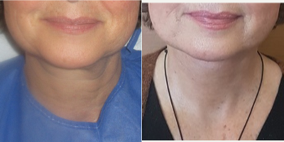 55-64 year old woman treated with Neck Lift - Patient bothered by horizontal wrinkles over her neck, as well as jowls with undefined jawline. Turkey neck.Underwent necklift under sedation, came for stitch removal 112 days post-op