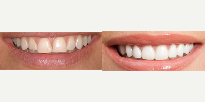 18-24 year old female treated with Lumineers - Wearing down and thinning teeth because of clenching and grinding. Patient was having sensitivity to biting and teeth would keep chipping the edges of her teeh with eating... She didnt want the enamel on her teeth filed so we elected to do Lumineers. Veneers that fit over the teeth with minimal filing of the enamel.&nbsp;
