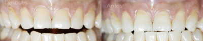 45-54 year old woman treated with Dental Bonding - Composite bonding on the front teeth to correct aesthetic details.