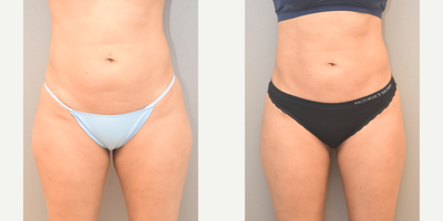35-44 year old woman treated with SAFELipo - 41 lipo abdomen, outer and inner thighs