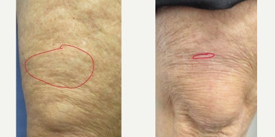55-64 year old woman treated with Lipoma Removal, Mole Removal - 62-year-old female before and 6 months after a removal of a benign lipoma above the knee. Procedure was done in the office under local anesthesia and took less than 10 minutes. The patient also used Dr. Sperons Natural Skin Care Scar Product after her 2 week checkup until the six month follow-up visit.