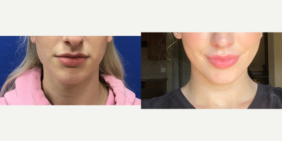 Patient treated with Chin Surgery - Chin Reduction and Contour - 21 year-old female patient is 3 months post-op from Facial Feminization surgery. Her procedures included: Forehead Lift, Hairline Lowering, Orbital Bony Contouring; Septorhinoplasty (Closed) with Cartilage Grafts, Radix Graft and Weirs; Cheek Implants (Small); Chin Reduction and Contour; Subnasal Lip Lift with Fat Augmentation to Lips; Thyroid Cartilage Shave and 300 Micrografts to Recessions.