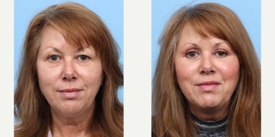 55-64 year old woman treated with Eyelid Surgery, Double Eyelid Surgery - Dr. Wise performed both an upper and lower blepharoplasty on this patient to remove excess skin around the patient's eyes and to remove the fat pads underneath.  This resulted in a smoother, youthful appearance of her eyes.