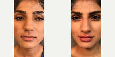 Woman treated with Lip Augmentation - Woman treated with Lip Augmentation as well as nonsurgical nose job