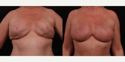 45-54 year old woman treated with Breast Reconstruction - breast implant revision with fat grafting