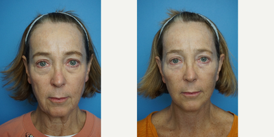 65-74 year old woman treated with Deep Plane Facelift - Deep plane High SMAS lift done with fat transfer
