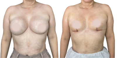 35-44 year old woman treated with Breast Implant Removal, Breast Reconstruction, Breast Lift - Breast implant removal is more than just removing the prosthesis and capsules. It's reconstructive surgery that has aesthetic goals for our patients. The great thing about this surgery is that we can use the patient's tissue for reconstruction, allowing immediate results. Plus, it's almost always painless and leaves an L-shaped scar with no scars in the cleavage area. Thanks to the BRALAN Technique(Breast Reconstruction Anatomical Lift Augmentation), we can achieve a consistent and stable aesthetic result regardless of breast tissue size.