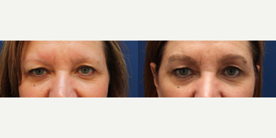 53 year old woman treated with Eyebrow Transplant - This is a 53 year old female who overplucked her eyebrows in the previous years and her hair follicles did not grow back.  She underwent an eyebrow hair transplant to restore her eyebrows naturally.