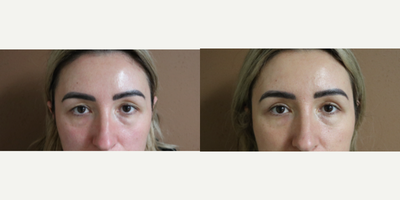 25-34 year old woman treated with Eyelid Surgery - Upper eyelid blepharoplasty performed in office under local anesthesia.