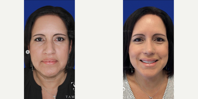 Woman treated with Mini Facelift, Rhinoplasty - Loving these results just 6 weeks after a mini face lift and open #rhinoplasty.She looks rejuvenated and refreshed following surgery. The nose has been contoured & refined giving her a natural look that fits her perfectly.