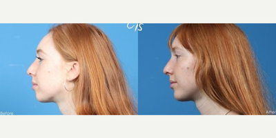 Woman treated with Chin Implant - Woman treated with Chin Implant