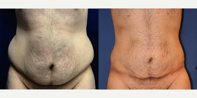25-34 year old man treated with Liposuction - Liposuction of abdomen & hips combined with exercise.