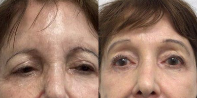 75 and up year old woman treated with Sofwave, Brow Lift - Sofwave brow lift done to lift eyebrows and upper eyelids of 80 year old woman