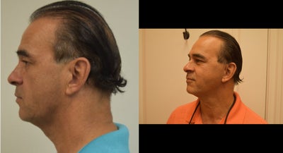 45-54 year old man treated with Mini Lift - Minilift in patient that wanted nasolabial folds and neck treated. The best is yet to come!