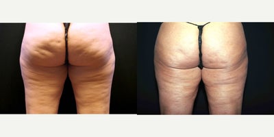 35-44 year old woman treated with Cellulaze - 36 year old female received Cellulaze to the thighs and buttocks; photos depict the patients results 3 months post-op.