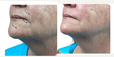 45-54 year old woman treated with Aquagold, Facial - REVIVIFY TREATMENT USING AQUAGOLD FINE TOUCH