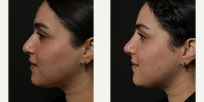 Woman treated with Nonsurgical Nose Job - Woman treated with Nonsurgical Nose Job