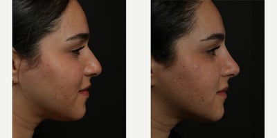 Woman treated with Nonsurgical Nose Job - Woman treated with Nonsurgical Nose Job