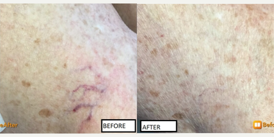 55-64 year old woman treated with Asclera for spider veins - This nice patient wanted to get rid of a large patch of spider veins on her leg. She was treated with Asclera and now