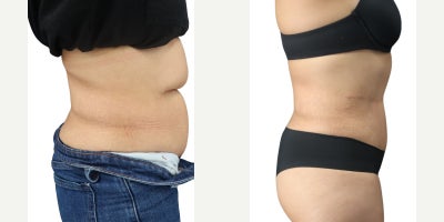 Woman treated with Tummy Tuck, Liposuction - Woman treated with Tummy Tuck, Liposuction