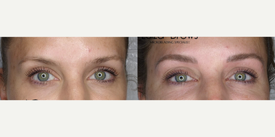 Woman treated with Microblading - Woman treated with Microblading