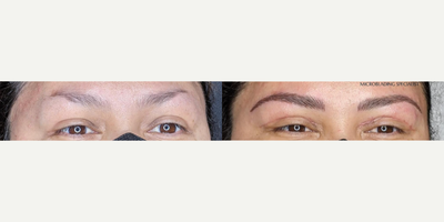 Woman treated with Microblading - Woman treated with Microblading. Patient is shown before and after touch up.