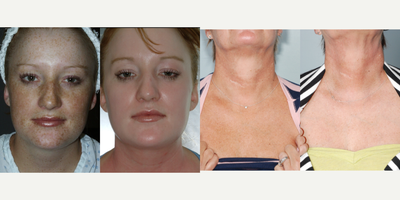 25-34 year old woman treated with TCA Peel - 20% TCA Peel
